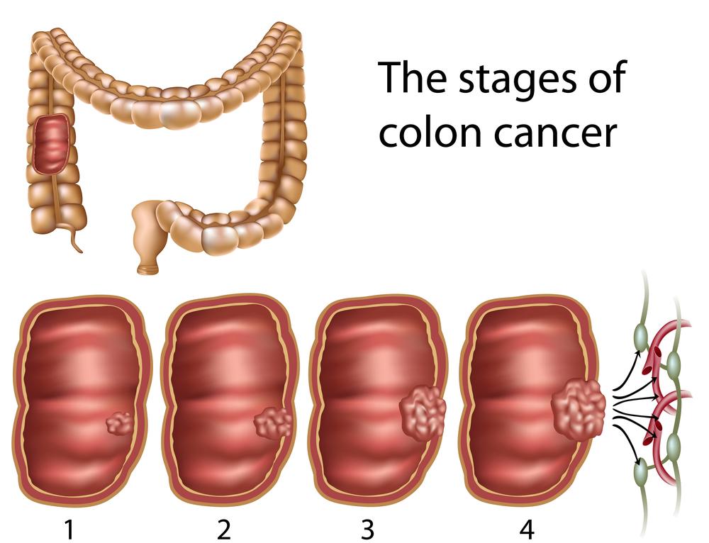 Things to know about colon cancer