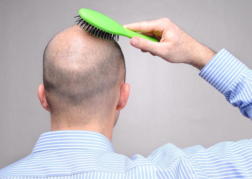 What, why, and how of hair loss