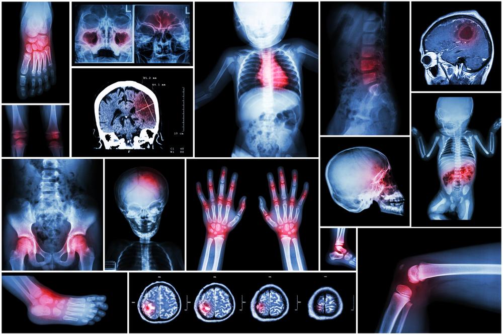 Overview: Rheumatoid Arthritis (RA)