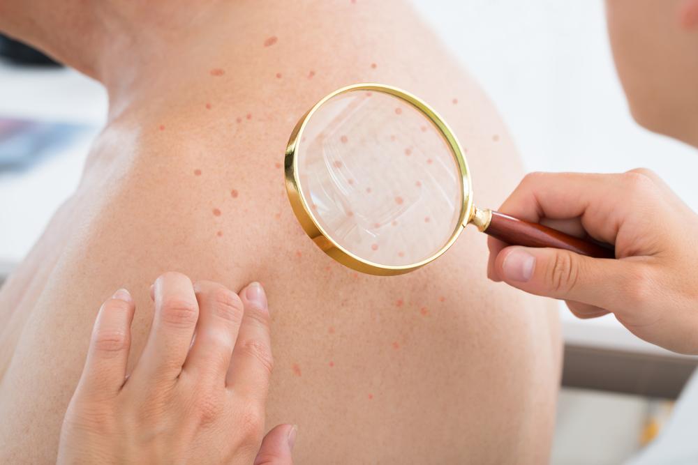Symptoms and Prevention of Melanoma