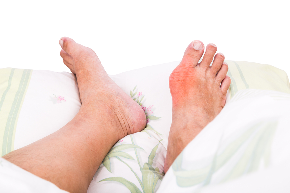 Diagnosing and Treating Gout