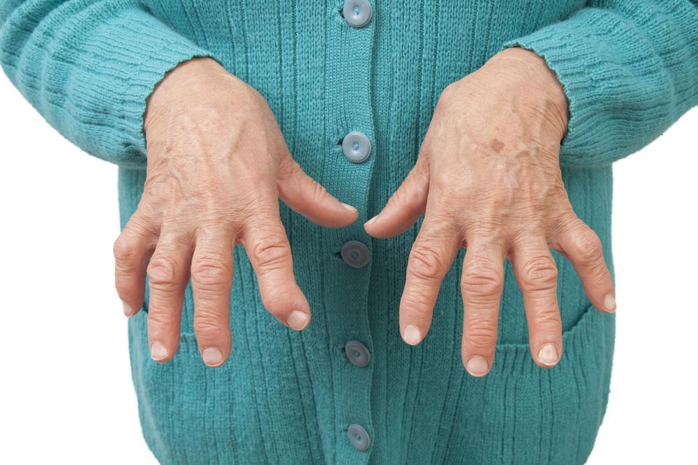 Signs and Symptoms of Rheumatoid Arthritis