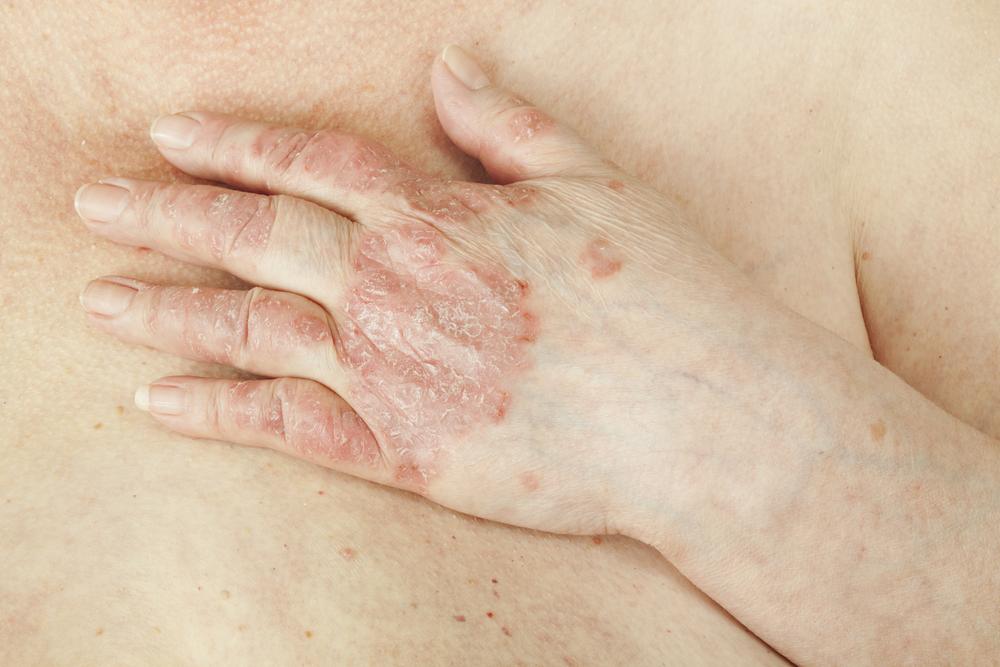 Overview – Causes Diagnosing Psoriasis