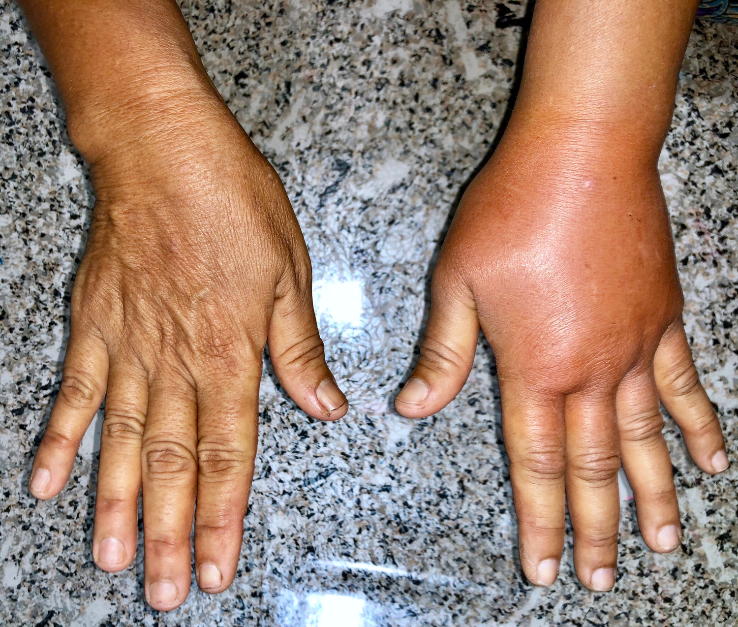 Foods That Trigger Hereditary Angioedema (HAE)
